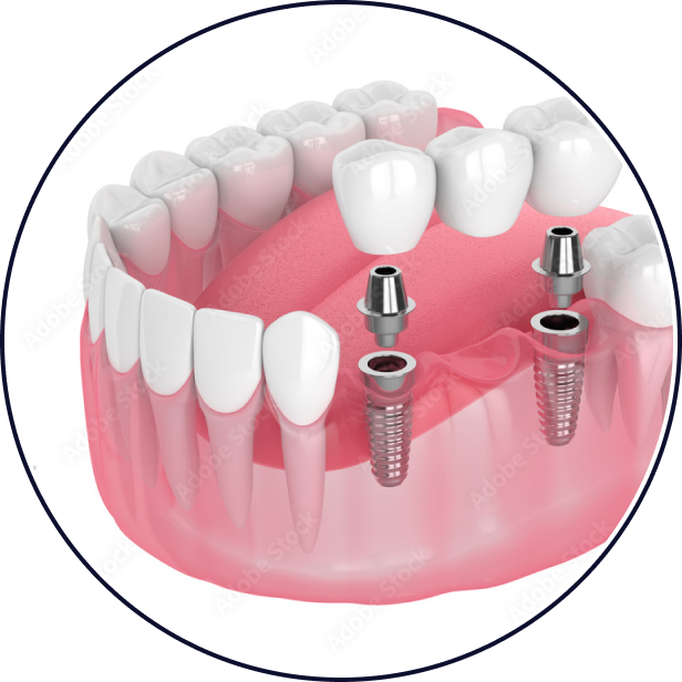 Bridge Implants