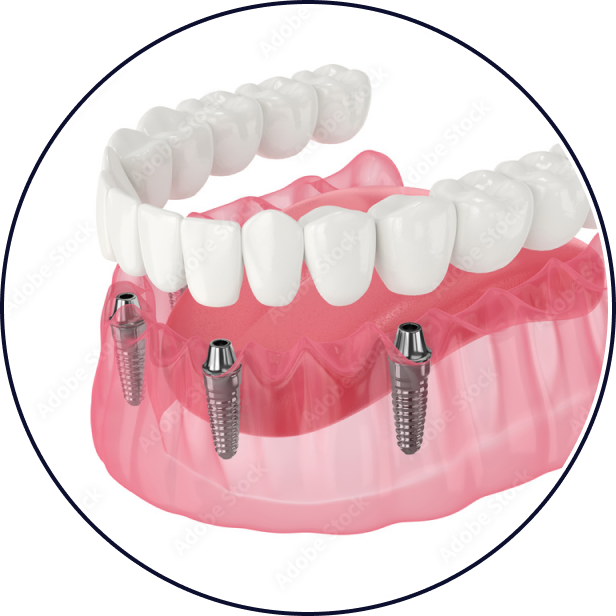 Full-Arch Implants