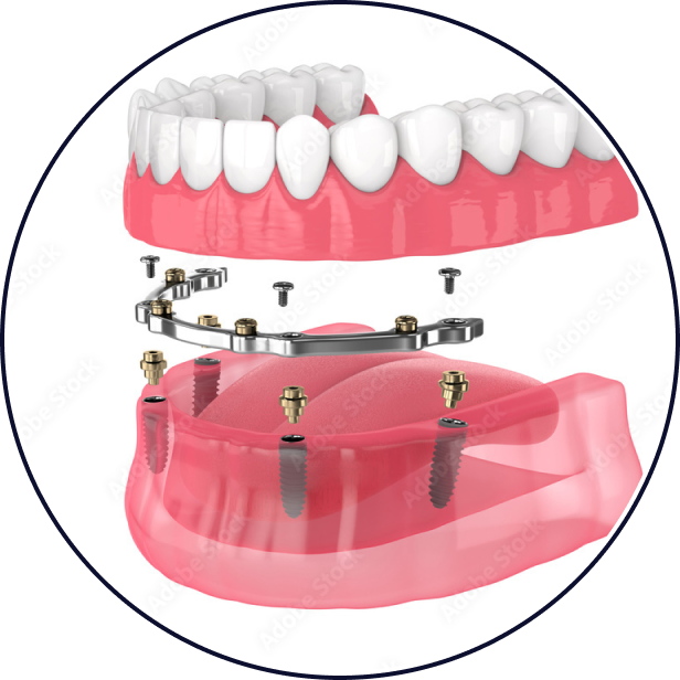 Hybrid Denture