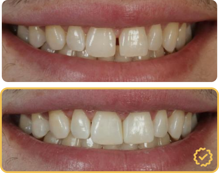 Clear Aligners Before After Comparison